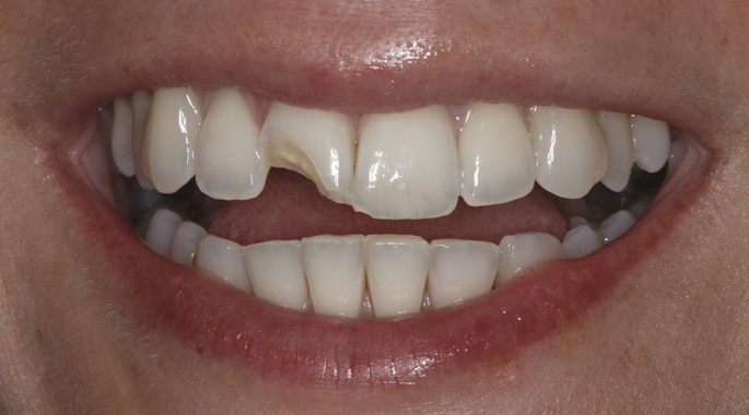 smile with chipped tooth