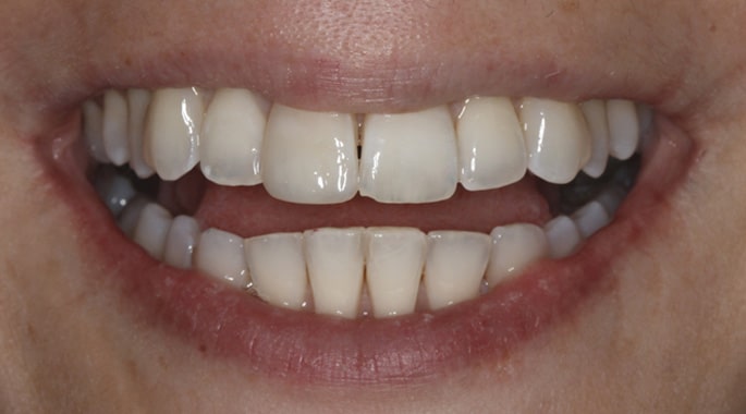 smile with no chipped teeth