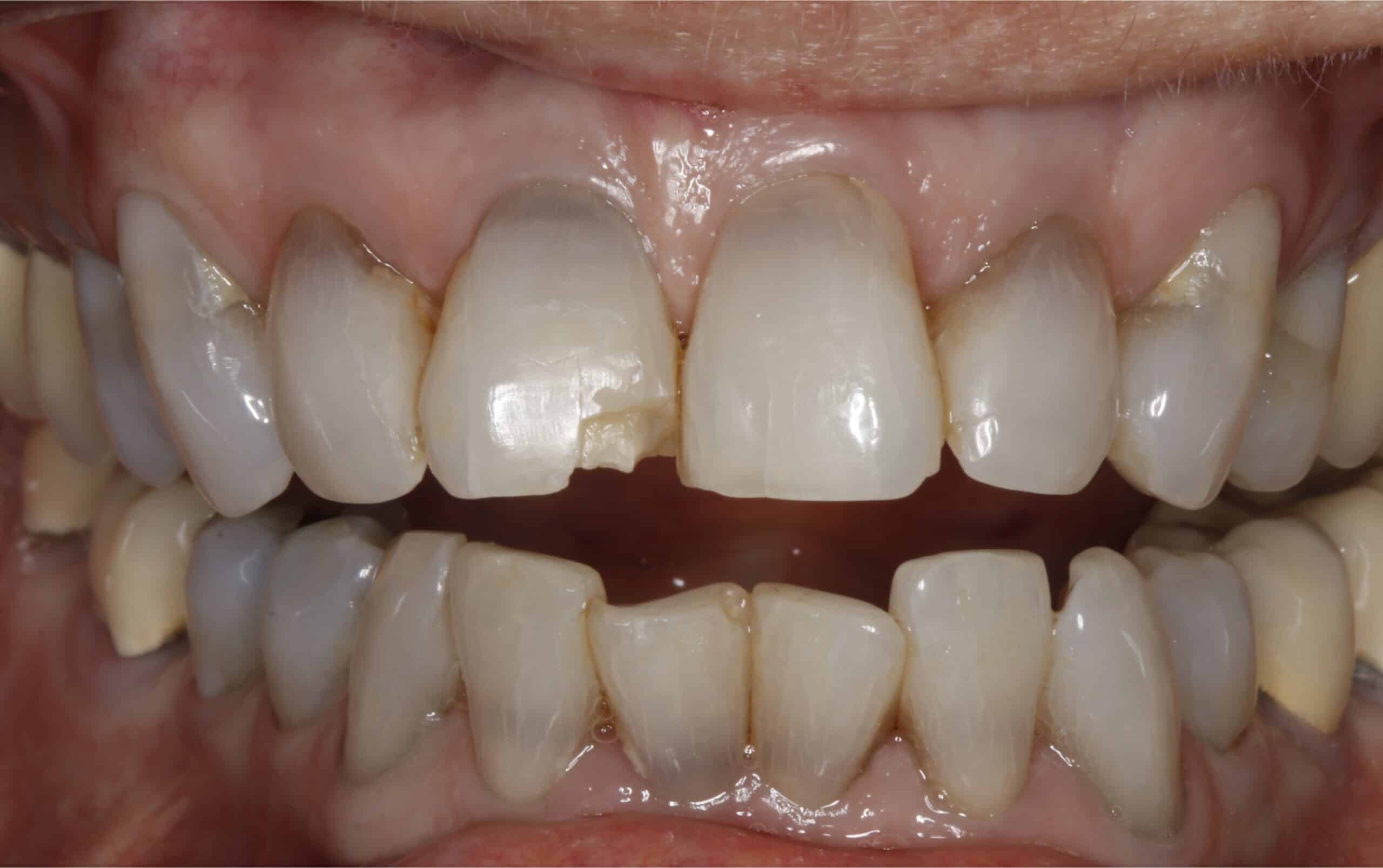 eddleman dental tooth chip before