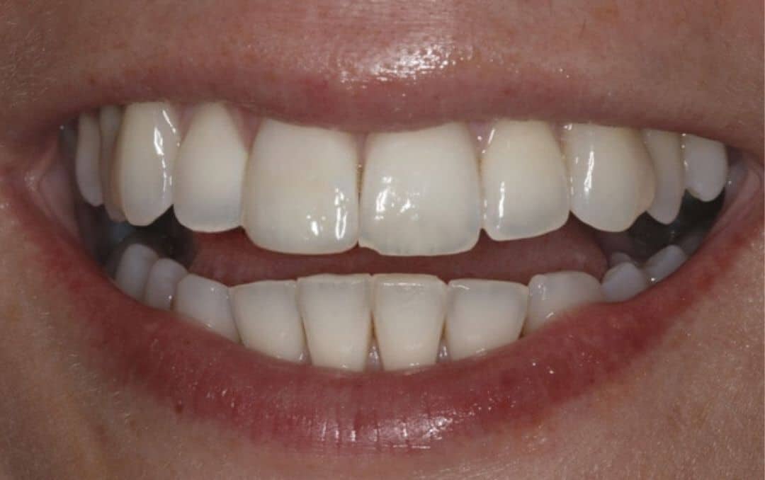 smile transformation after treatment