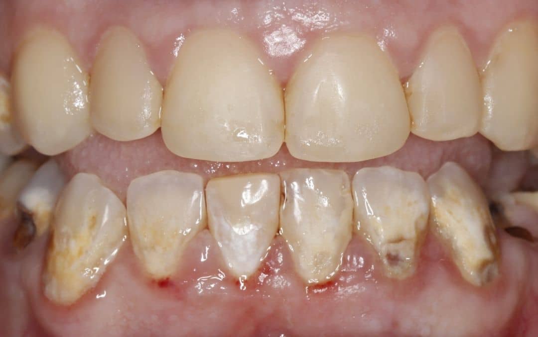 eddleman smile transformation after treatment