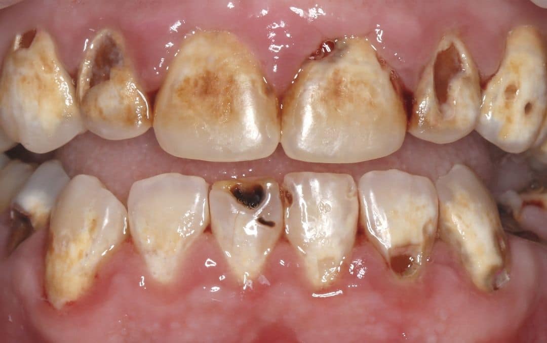 eddleman smile transformation before treatment