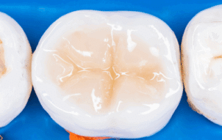 a row of teeth on a blue surface with composite fillings