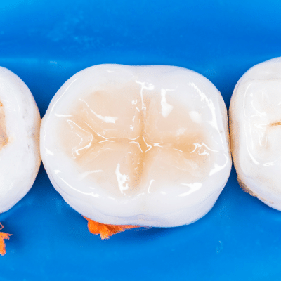 a row of teeth on a blue surface with composite fillings