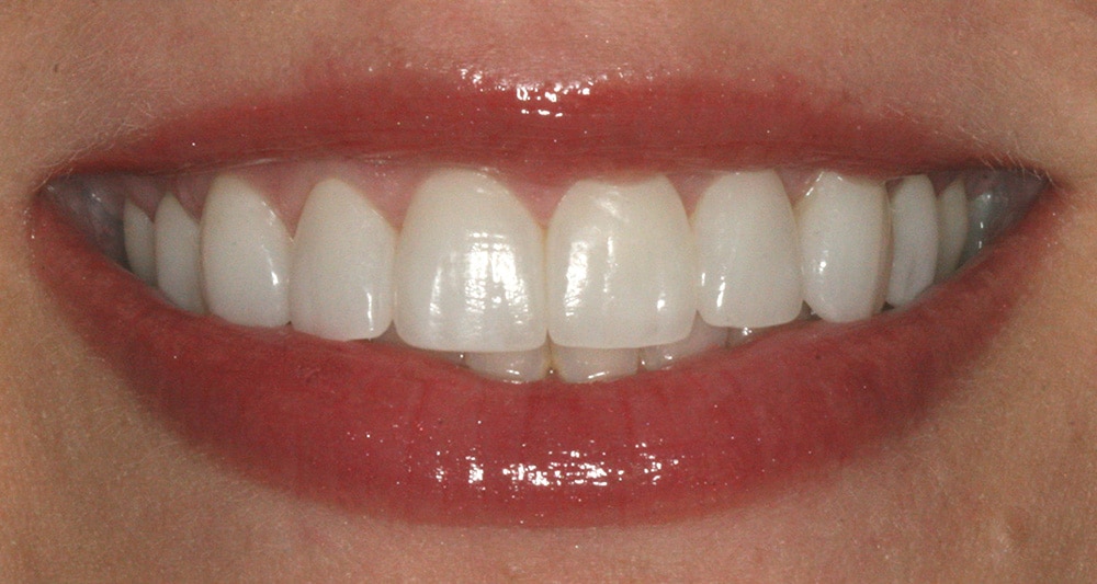 Patient smile after treatment beautiful straight teeth