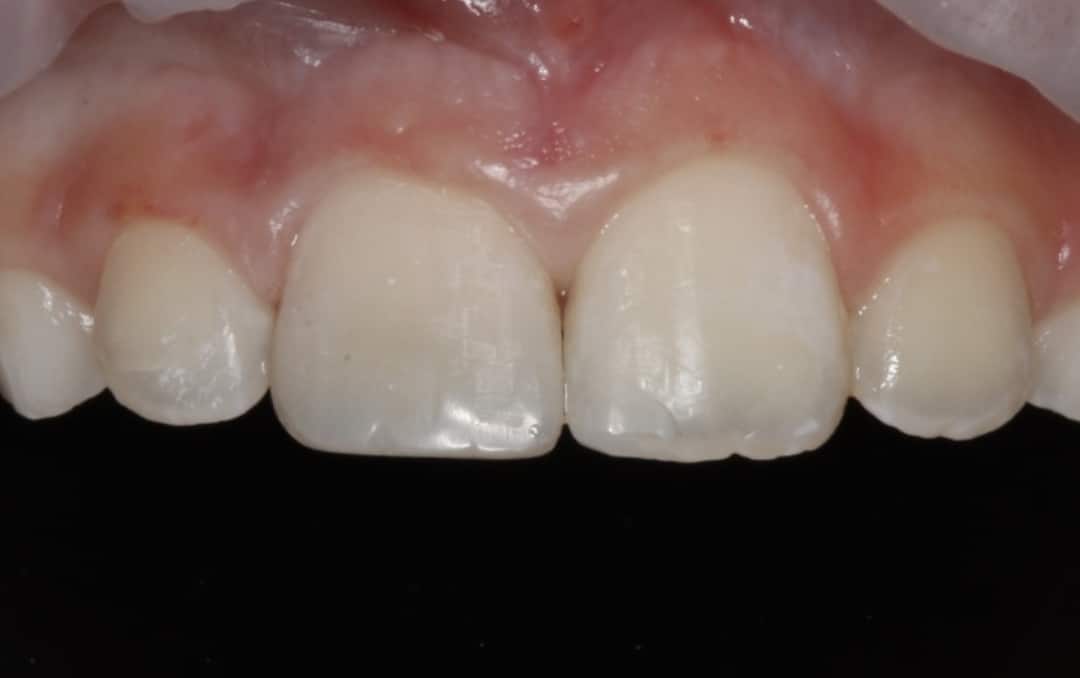 Close up photo of patient's top teeth after the front tooth has been repaired from chipping