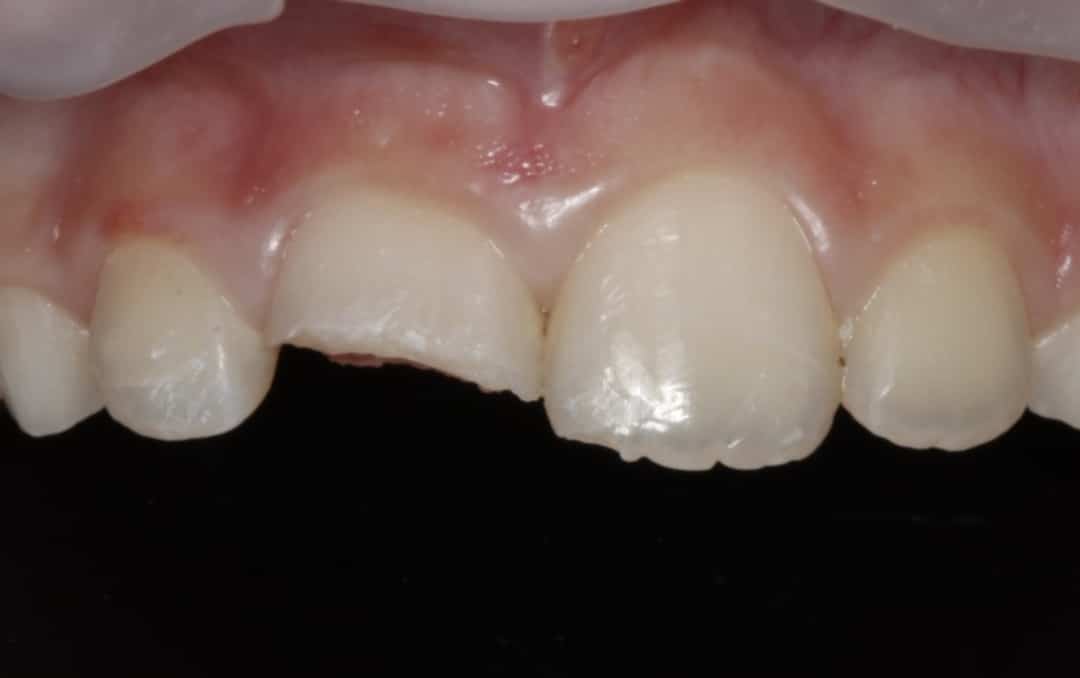 Close up photo of patient's top teeth, with half the front tooth missing