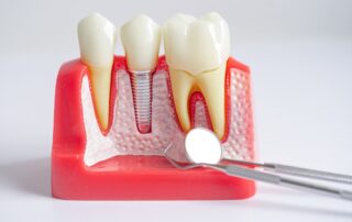 10 signs to know a dental implants candidate