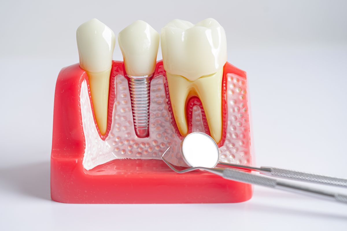 10 signs to know a dental implants candidate
